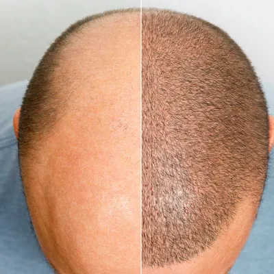 تجربتي مع زراعة الشعر في تركيا: الحقيقة وراء "خطوط الشعر التركية" لعلاج الصلع
