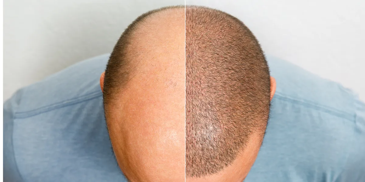 تجربتي مع زراعة الشعر في تركيا: الحقيقة وراء "خطوط الشعر التركية" لعلاج الصلع