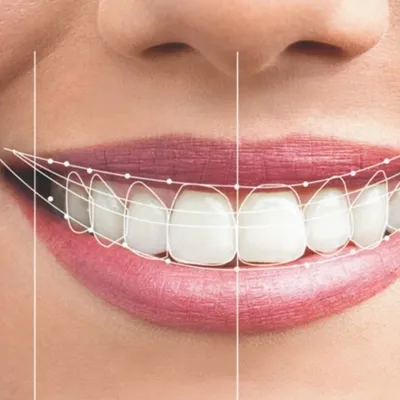خداحافظی با خمیر دندانپزشکی؛ چرا طراحی لبخند دیجیتال (DSD) جایگزین روش‌های سنتی شد؟
